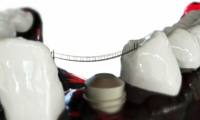 implant dentar în Bucureşti